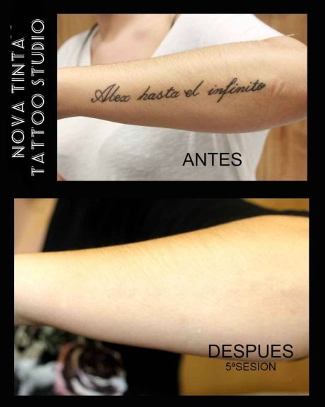 Maquina de borrar tatuajes Nova Tinta Tatoo
